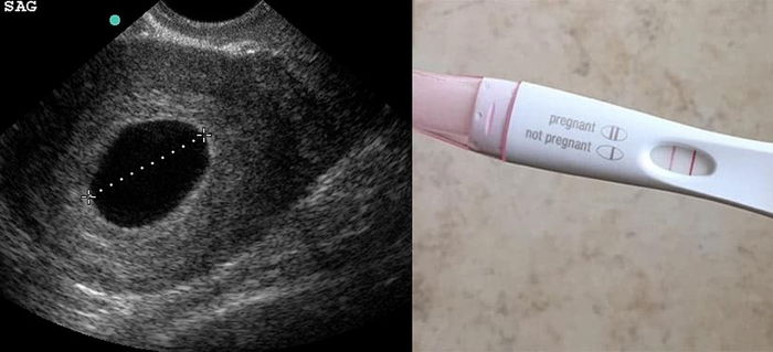 UPT Positif, Tapi Scan Tiada Kantung Dalam Rahim, Apa Sebab Kantung Tak Nampak?
