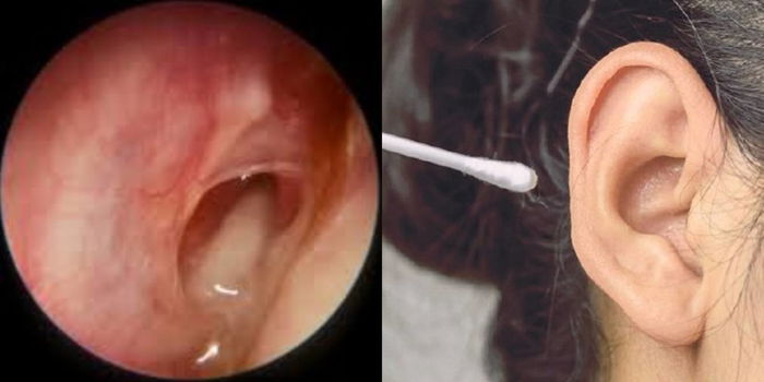 Elakkan Guna Putik Kapas, Wanita Ini Alami Jangkitan Kuman Hingga Pekak Seumur Hidup!