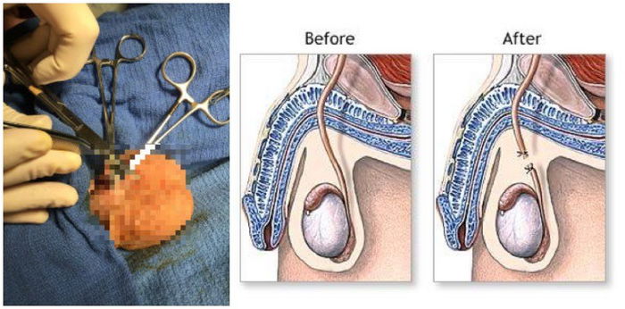 Kaedah Merancang Keluarga Paling Berkesan, Ini Senarai dan Kos Pembedahan Vasektomi Di Malaysia