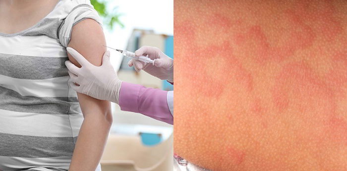 Ibu Hamil Boleh Alergi Pada Suntikan Tetanus Dan Alami Keradangan Kulit!