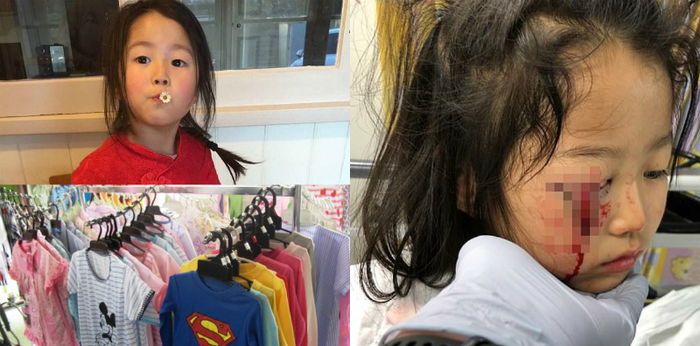 Budak Perempuan Ini Nyaris Buta Selepas Matanya Terkoyak Pada Besi Penyangkut Baju Di Sebuah Butik