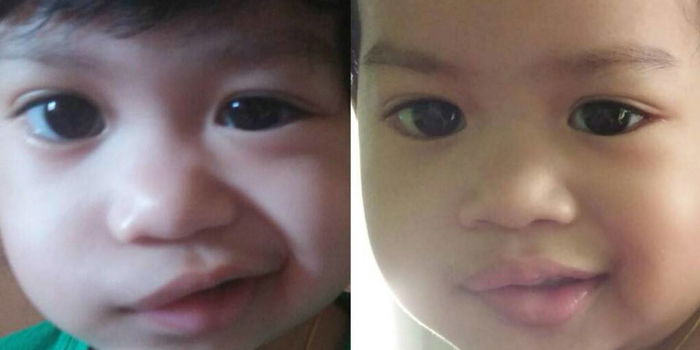 Ingat Sengaja Buat Mulut Senget, Rupanya Anak Hidap Bell Palsy Akibat Korek Telinga!