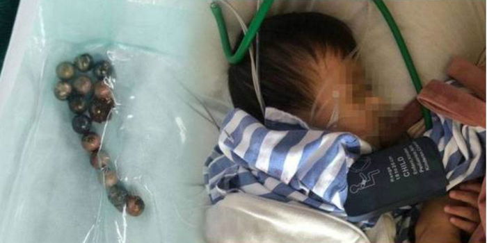 Perut Bayi BERLUBANG @ Koyak Lepas Tertelan Mainan Magnet Berbentuk Bebola