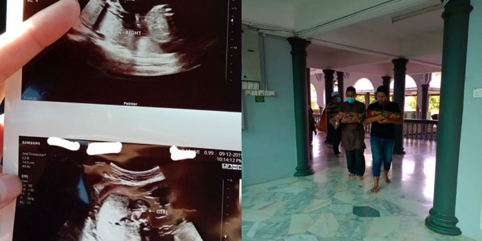 Jangan Percaya Tiada Ruang Punca Baby Kurang Gerak, Ibu Ini Kematian Baby Kembar Dalam Kandungan