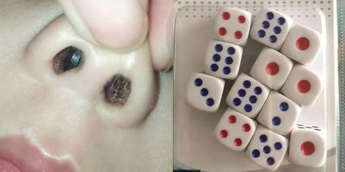 Doktor Terkedu Dadu 3 Tahun Dalam Hidung, Akhirnya Anak Mengaku Bahawa...