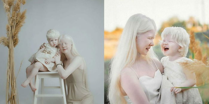 Keunikan Diri Albino, Dua Beradik Curi Perhatian Dunia Dengan Kecantikan Luar Biasa