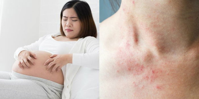 7 Jenis Alergi Kulit Ketika Hamil Boleh Mempengaruhi Janin, Ini Yang Ibu Wajib Tahu!