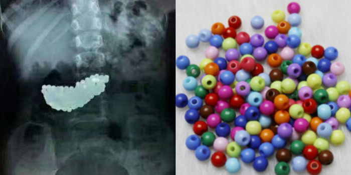 Budak 5 Tahun Tertelan 190 Biji Manik, Ibu Ayah Sila Ambil Iktibar & Bertindak Cepat!