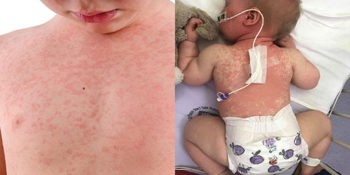 Measles Berbahaya, Boleh Sebabkan Kecacatan Otak Jika Lambat Diubati!
