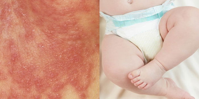 Atasi Ruam Lampin Yang Buat Anak Anda Tak Selesa Dengan 4 Cara Ini!