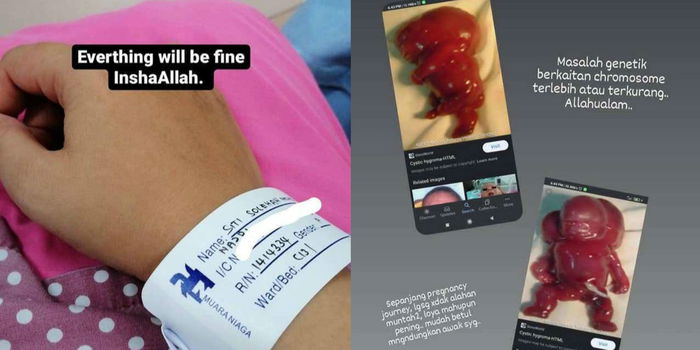 Janin Alami Cystic Hygroma & Meninggal Dalam Kandungan, Ibu Jangan Abaikan Asid Folik!