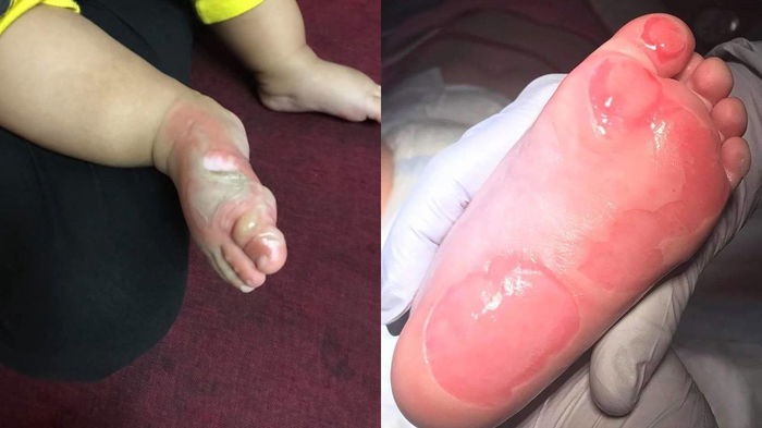 Doktor Pesan Jangan Letak Ubat Gigi Pada Kulit Anak Yang Melecur!