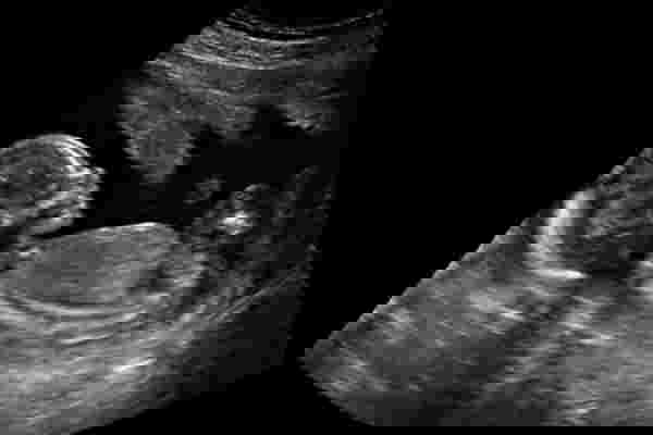 imbasan ultrasound
