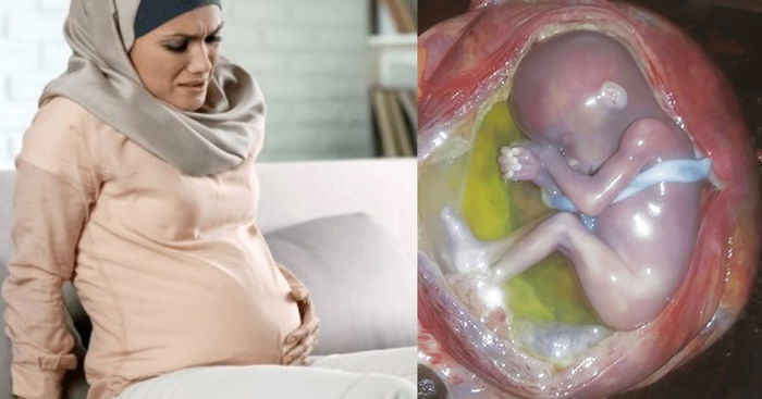 Jangan Panik Bila Air Ketuban Pecah! Ini Yang Anda Patut Lakukan