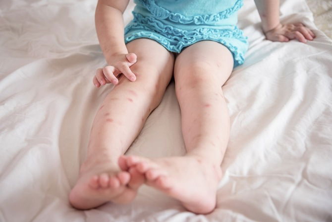 Symptoms of Dengue Parents Might Miss Out