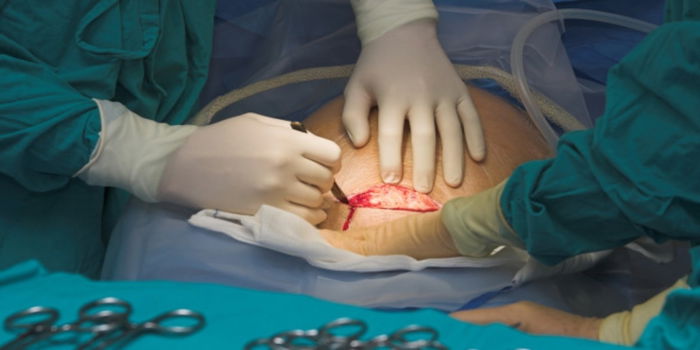 Doktor Bukan Saja-Saja Nak Caesar, Ini 4 Tahap Caesaran Yang Mungkin Anda Akan Alami Ibu Hamil!