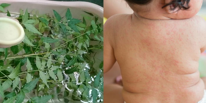 Demam Campak Bayi (Measles): Punca, Tanda Dan Rawatan