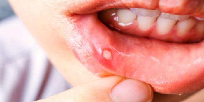 7 Cara Hilangkan Ulser Mulut Pada Anak Kecil & Orang Dewasa Yang Terbukti BERKESAN