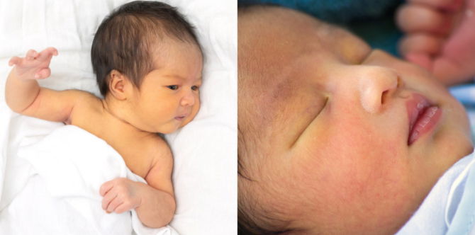 Bayi Kuning/Jaundis Boleh Berterusan Lebih 30 Hari, Begini Panduan Yang Betul Mengatasinya!