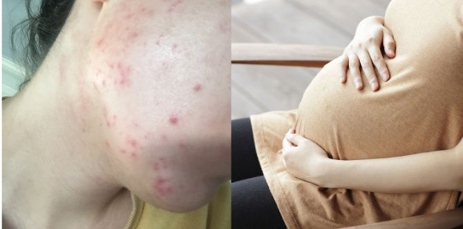 Jerawat Ketika Hamil (Pregnancy Acne): Punca Naik Jerawat, Simptom & Cara Hilangkan Jerawat