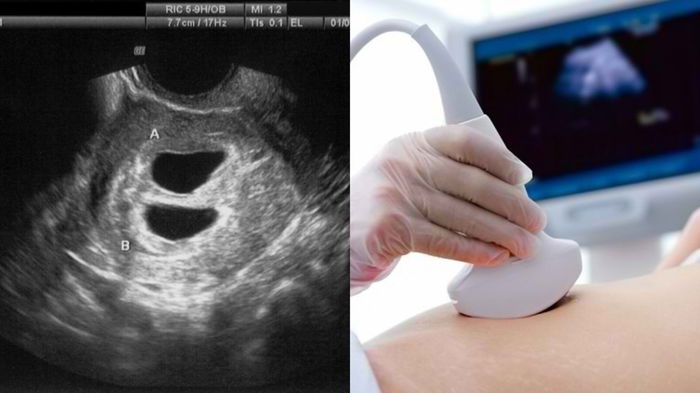 UPT Positif, Tetapi Bila Scan Kantung Kosong, Kenapa? 9 Tanda Kehamilan Kosong Anda Patut Tahu!