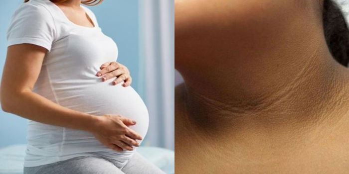 Ini Rupanya Punca Tompok Hitam Pada Kulit Badan Ketika Hamil, Adakah Akan Hilang?