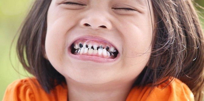 Bila Gigi Anak Anda Patah Ibu Bapa Jangan Panik! Lakukan Perkara Ini!