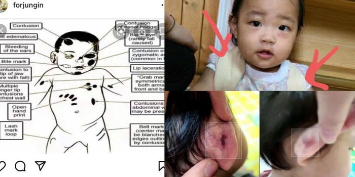 Bayi Diseksa Kejam 271 Hari Oleh Ibu Angkat Hingga Mati, Sila Alert Tanda Penderaan Ini!