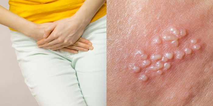 Keputihan Berbau Busuk, Warna Coklat? Awas! Anda Mungkin Hidap Penyakit Kelamin Pada Wanita!