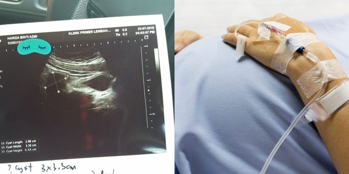 Cyst Ketika Hamil, Adakah Selamat Jika Ibu Mengandung Melalui Proses Pembedahan?