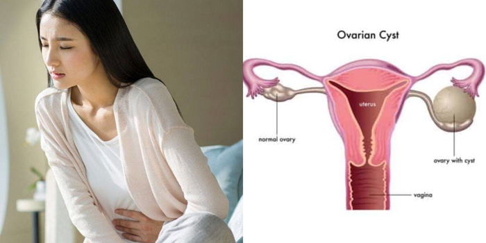 Cara Kecutkan Cyst Yang Disarankan Oleh Doktor Pakar Tanpa Melalui Proses Pembedahan