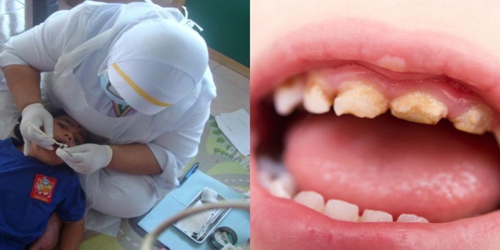 "Anak Saya Diberikan Sapuan Flourida Semasa Rawatan Gigi Di Sekolah, Untuk Apa?"