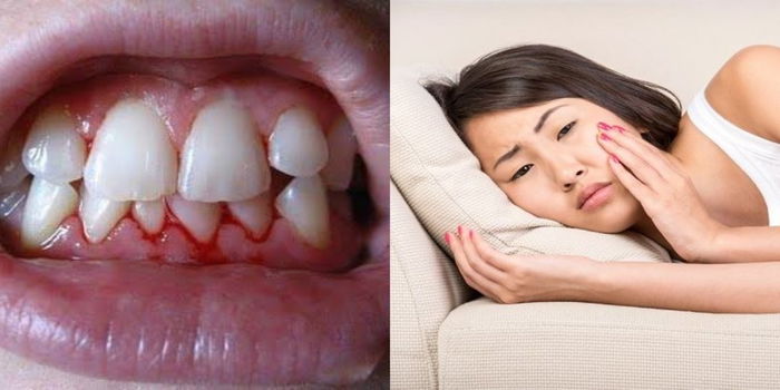 Gusi Ibu Hamil Berdarah Lepas Gosok Gigi? BAHAYA, Berisiko Praeklampsia & Kelahiran Pramatang!