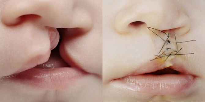 Jika Sudah Ditakdirkan Bayi Sumbing, Usah Terlalu Risau, Ikut 11 Tips Ini!