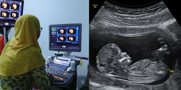 Masalah Buah Pinggang Bengkak Pada Bayi Dalam Kandungan, Adakah Ia Boleh Sembuh?