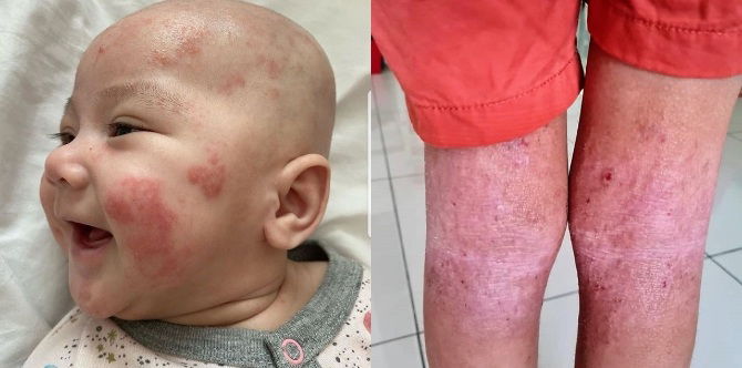 Penyakit Dermatitis Atopik Pada Bayi Boleh Terjadi Sehingga Dewasa, Ini Penjelasan Pakar