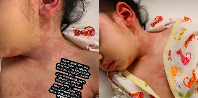 Penyakit Kawasaki Pada Anak, Ibu Sila Waspada Jika Anak Demam Lebih 4 Hari & Naik Ruam!