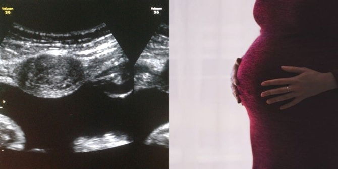 Dikesan Ada Fibroid Ketika Hamil 7 Bulan, Bolehkah Ibu Bersalin Normal? Ini Penjelasan Doktor
