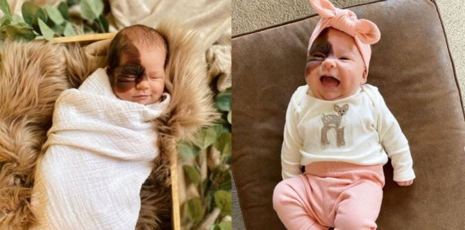 Bayi Perempuan Comel Raih Perhatian Ramai, Miliki Tanda Lahir Unik Pada Wajahnya