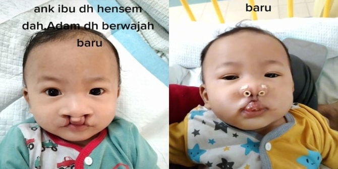 "Anak Ibu Dah Hensem!" Wanita Kongsi Wajah Anak Lepas Pembedahan Mulut Sumbing , Comel Betul!
