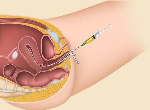 lahirkan anak pertama