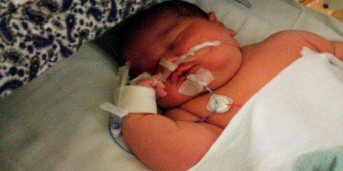 Bayi Ini Digelar 'Baby Hippo', Dilahirkan Pada Usia Kandungan 38 Minggu, Dengan Berat Bayi 6.35 KG!