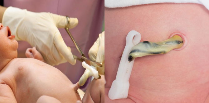 Elak Buat 5 Perkara BAHAYA Ini Semasa Menjaga Tali Pusat Bayi Baru Lahir, Alert Ya Ibu!