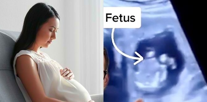 Tanda Mengandung Luar Rahim/ Kehamilan Ektopik, Ia Boleh Membahayakan Nyawa Ibu