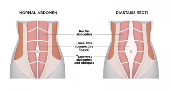 Diastasis recti