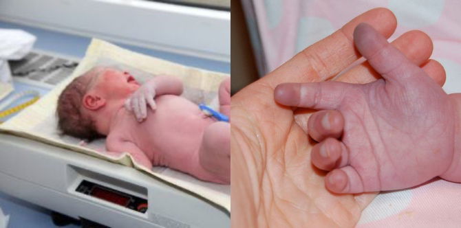 Baby Blue Syndrome - Ketahui Punca, Simptom & Cara Rawatan Untuk Elak Bayi Bertambah Teruk!