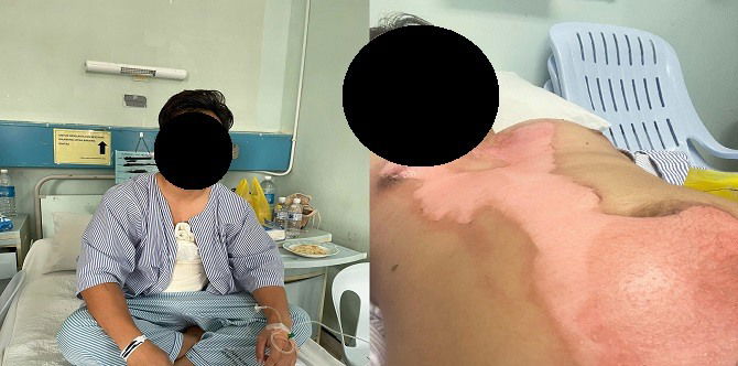 Tersalah Cara Guna Pressure Cooker, Sup Panas Tersembur Ke Muka & Badan Hingga Melecur Teruk