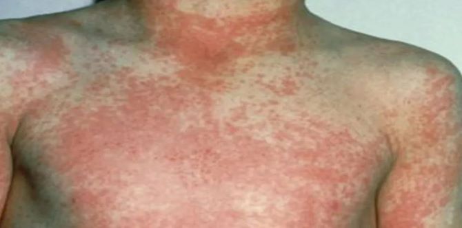 Kes Demam Scarlet Merebak Di England, Ibu Bapa Diberi Amaran Berwaspada