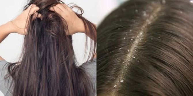 Kulit Kepala Kering Dan Mengelupas Buat Rasa Tidak Selesa, Ini Tips & Cara Mengatasinya!