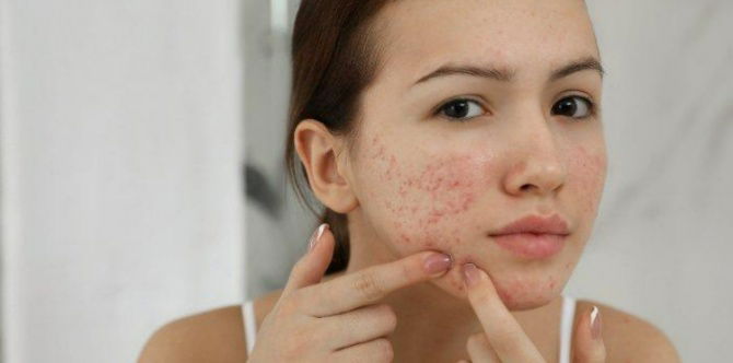 Cara Hilangkan Jerawat Dengan Cepat & Berkesan, Ramai Tak Tahu 10+ Rahsia Ini!
